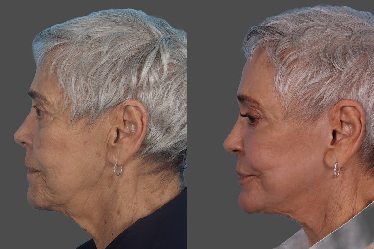 Facial Fat Transfer Before & After Gallery - Patient 268653 - Image 5