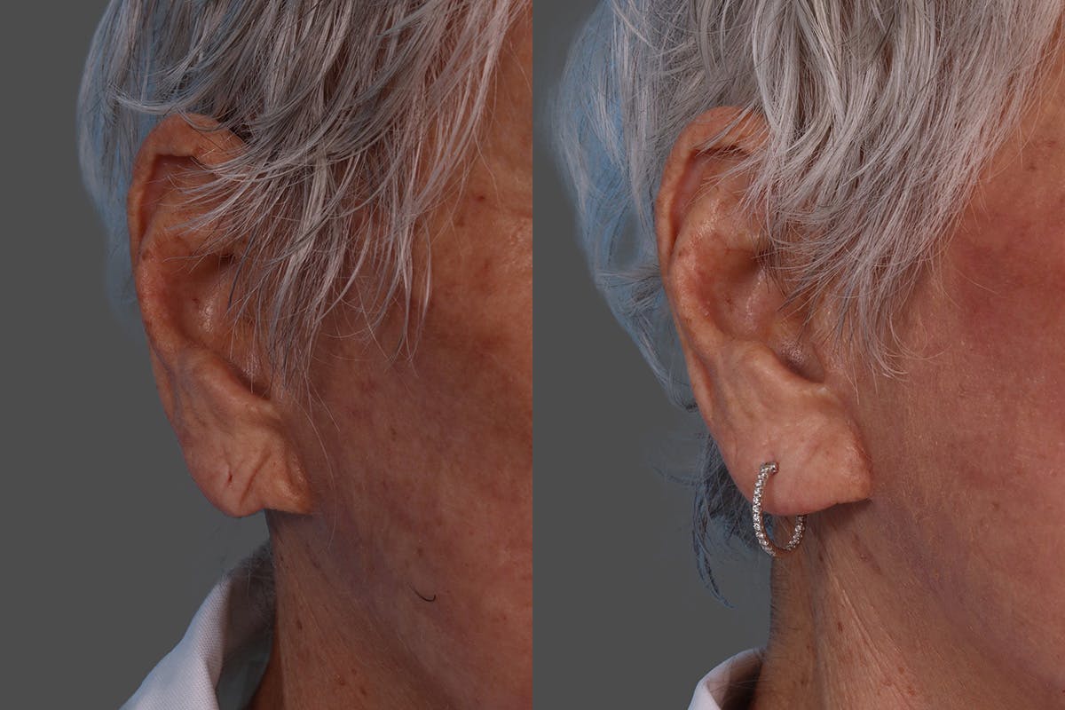 Revance RHA Before & After Gallery - Patient 566987 - Image 7