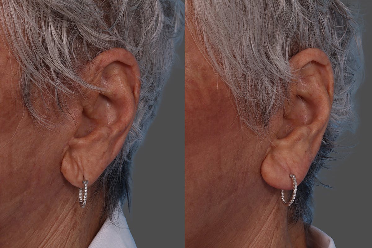 Revance RHA Before & After Gallery - Patient 566987 - Image 8