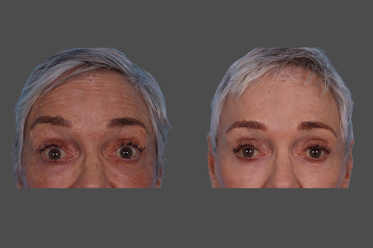 BOTOX® Before & After Gallery - Patient 174784 - Image 6