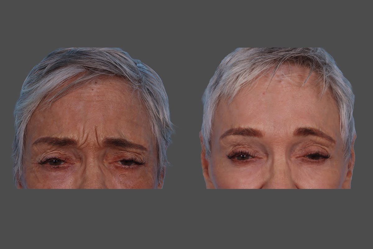 BOTOX® Before & After Gallery - Patient 174784 - Image 7