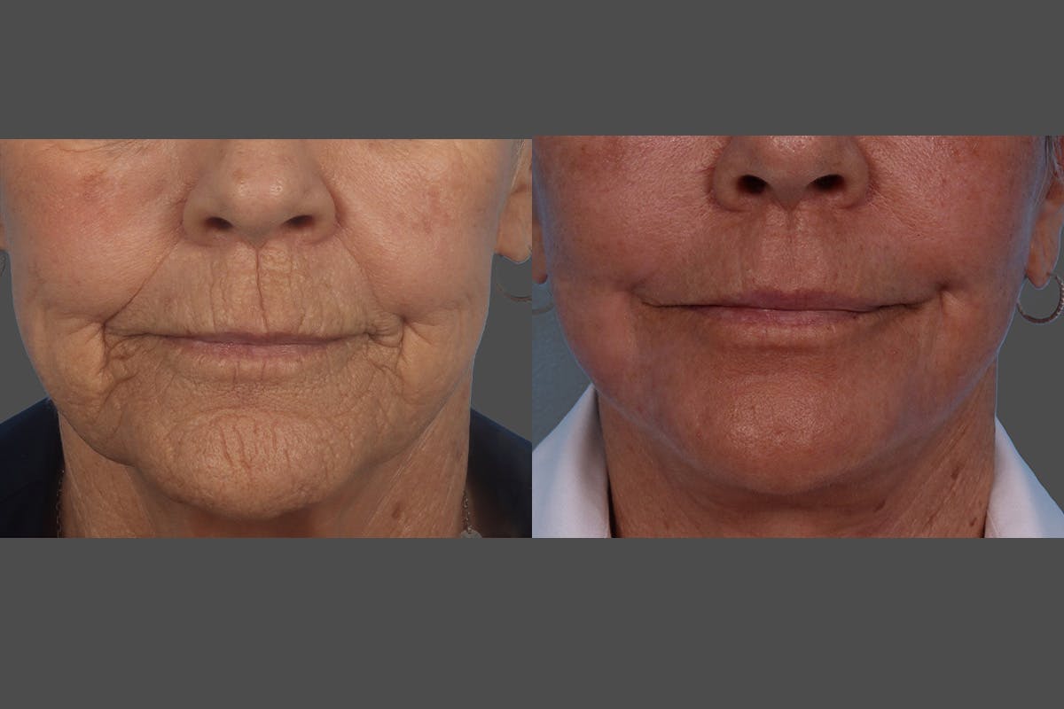 BOTOX® Before & After Gallery - Patient 174784 - Image 8