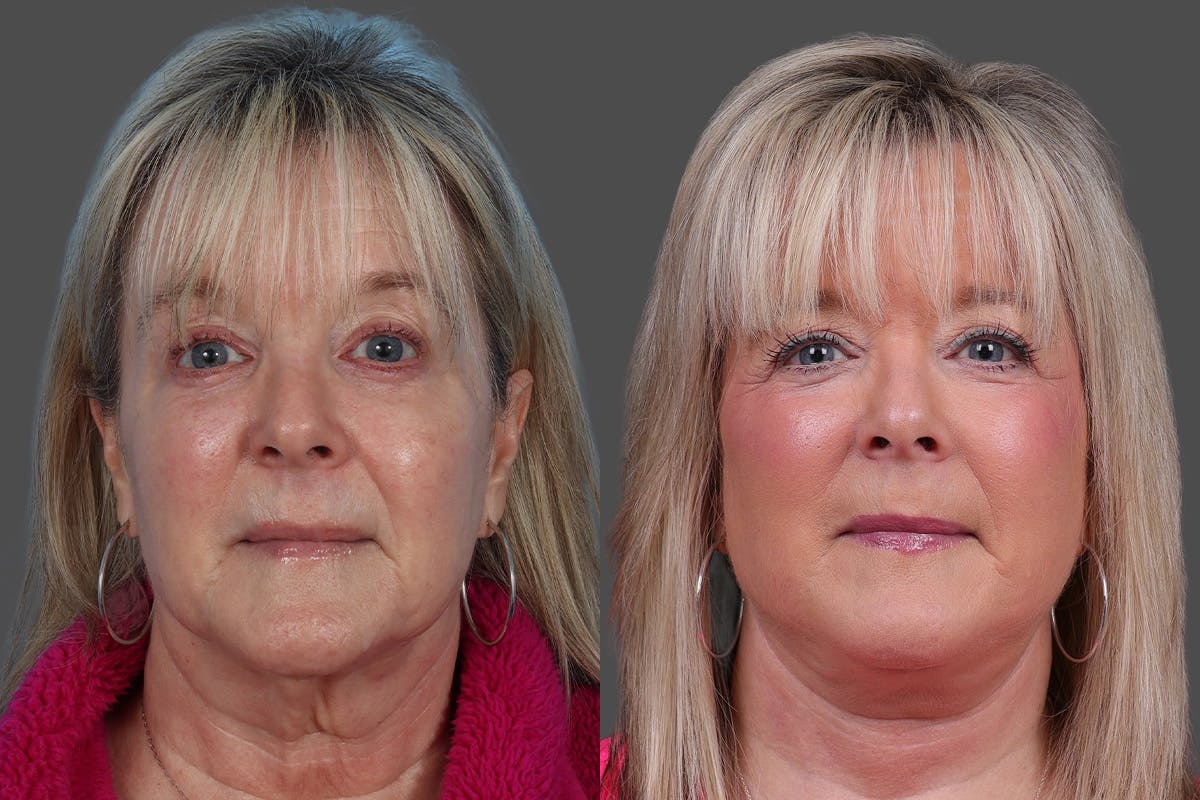 Facelift Before & After Gallery - Patient 201456 - Image 1