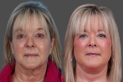Facelift Before & After Gallery - Patient 201456 - Image 1
