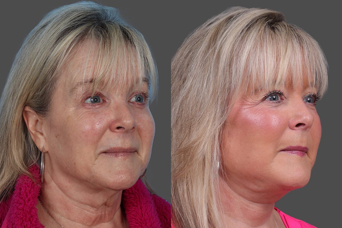 Facelift Before & After Gallery - Patient 201456 - Image 2