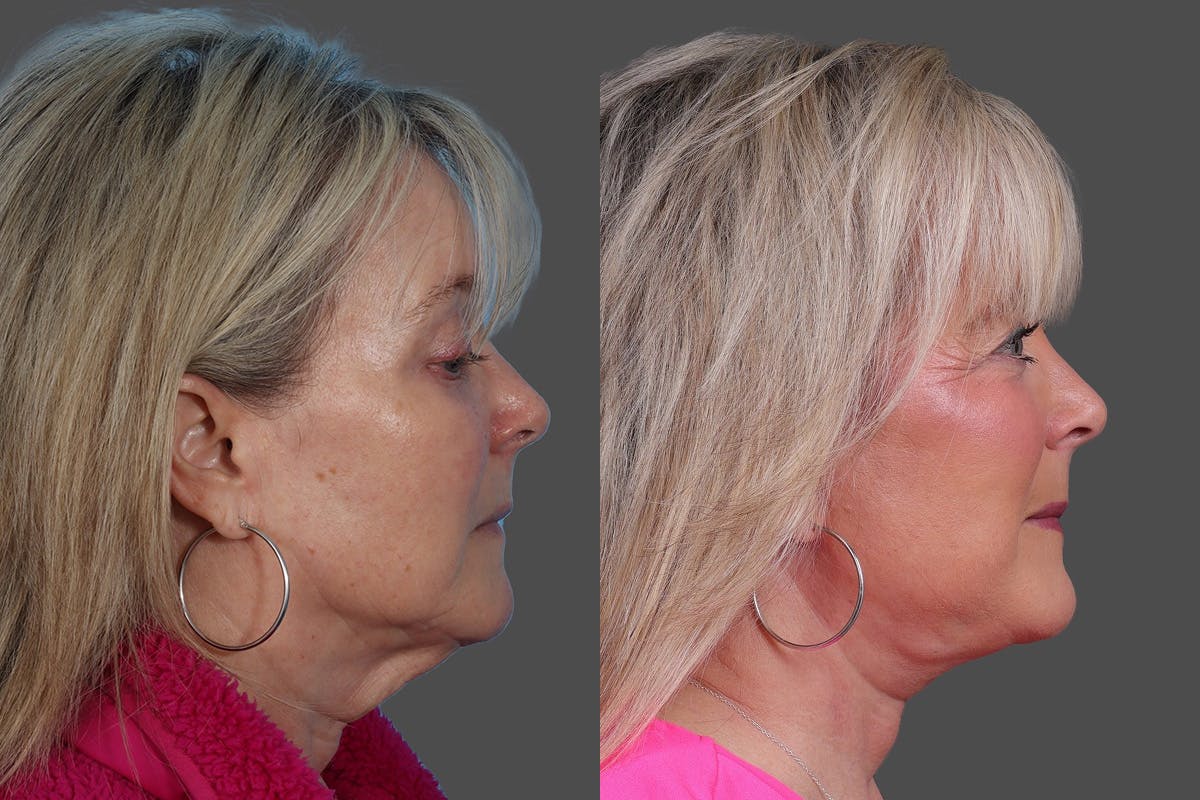 Facelift Before & After Gallery - Patient 201456 - Image 3