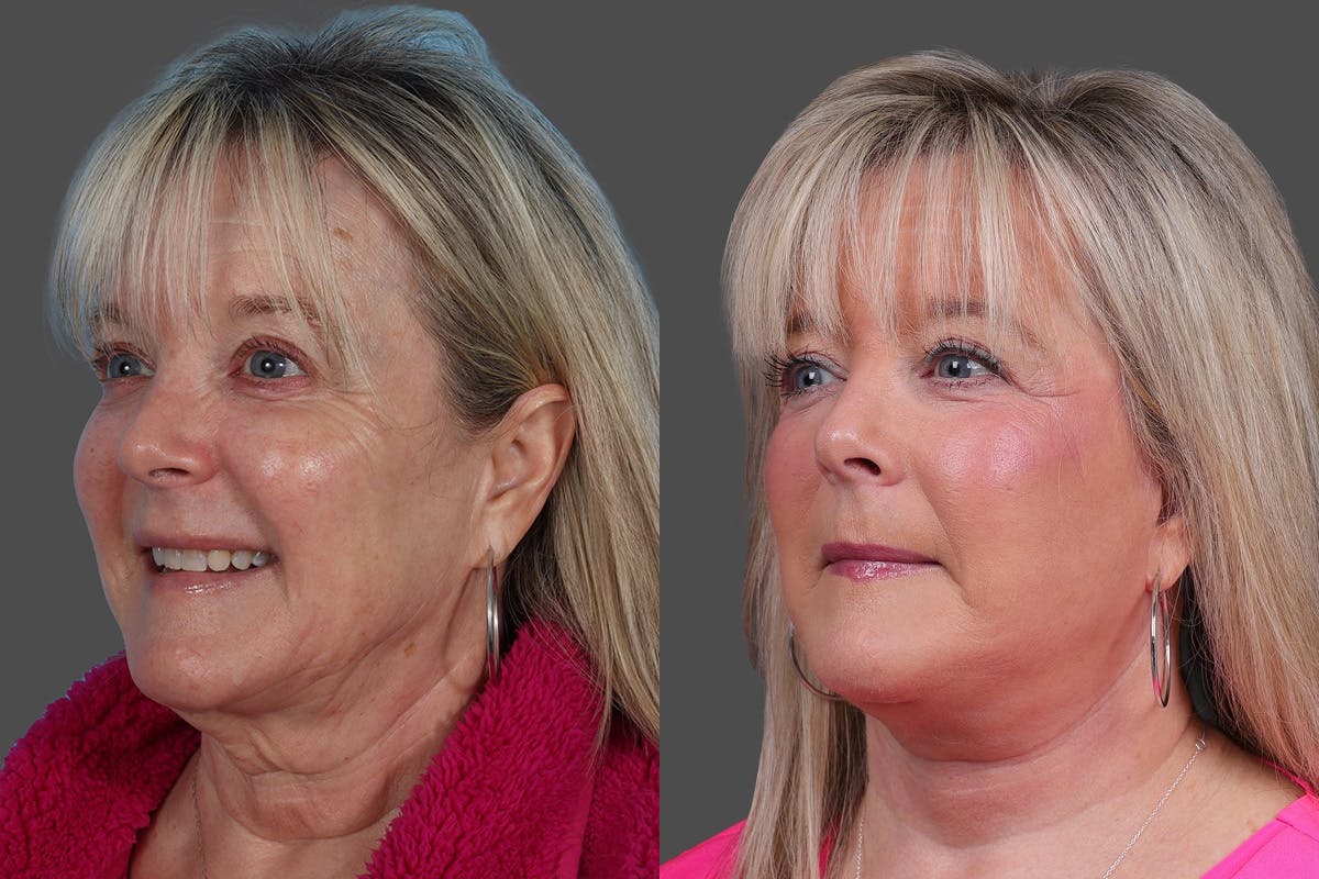 Facelift Before & After Gallery - Patient 201456 - Image 4