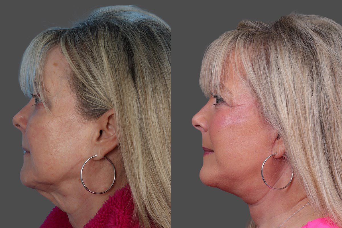 Facelift Before & After Gallery - Patient 201456 - Image 5