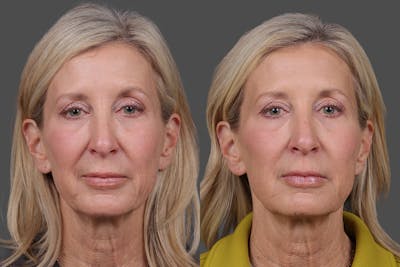 BOTOX® Before & After Gallery - Patient 146789 - Image 1