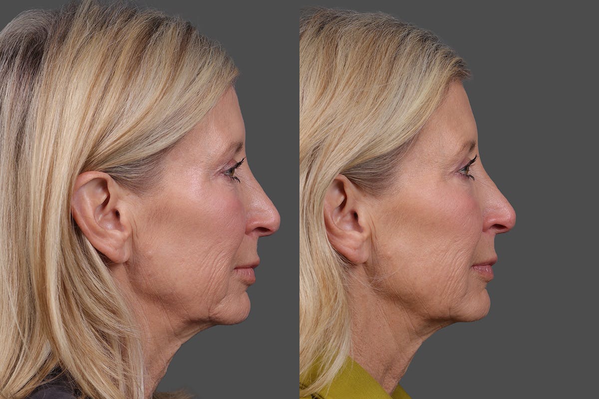 BOTOX® Before & After Gallery - Patient 146789 - Image 3