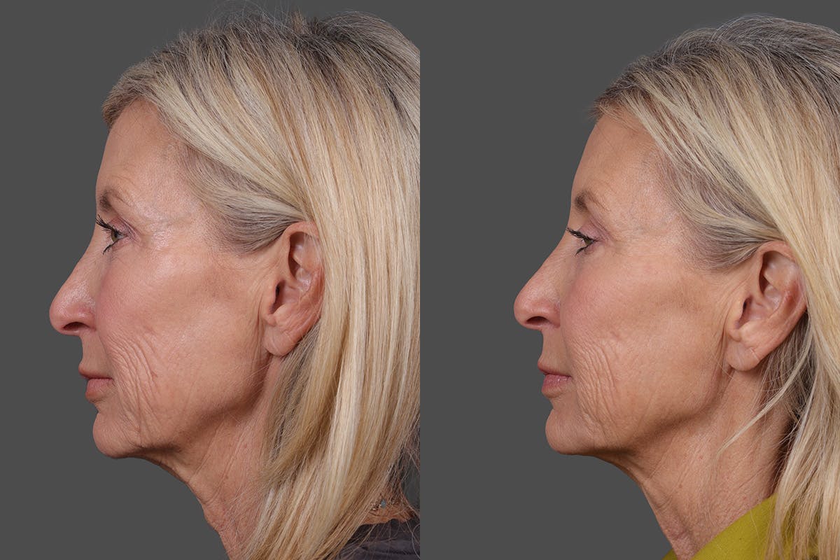 BOTOX® Before & After Gallery - Patient 146789 - Image 5