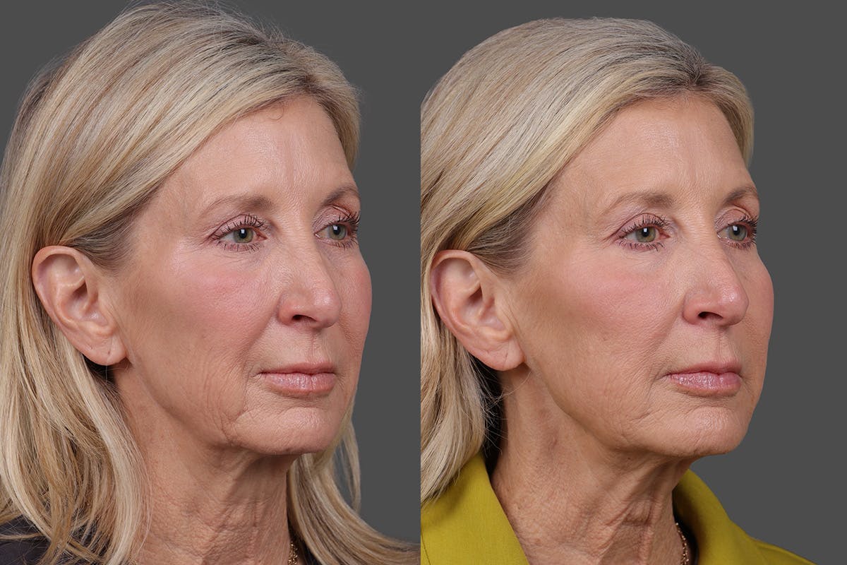 BOTOX® Before & After Gallery - Patient 146789 - Image 2