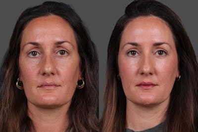 Eyelid Surgery (Blepharoplasty) Before & After Gallery - Patient 398173 - Image 1