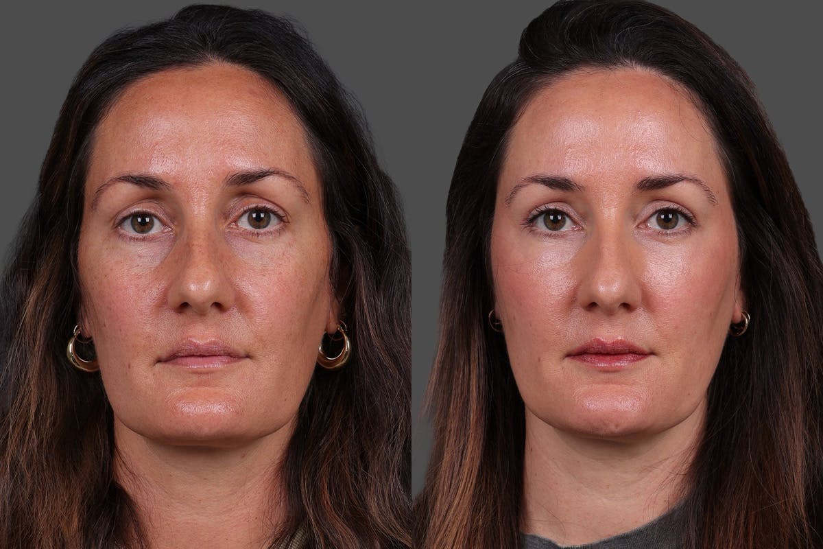 Eyelid Surgery (Blepharoplasty) Before & After Gallery - Patient 398173 - Image 1