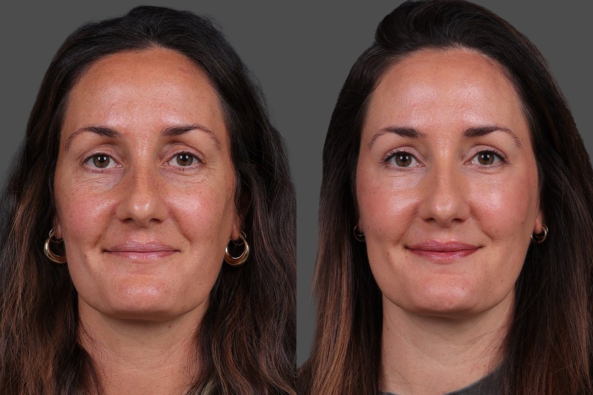 Eyelid Surgery (Blepharoplasty) Before & After Gallery - Patient 398173 - Image 2
