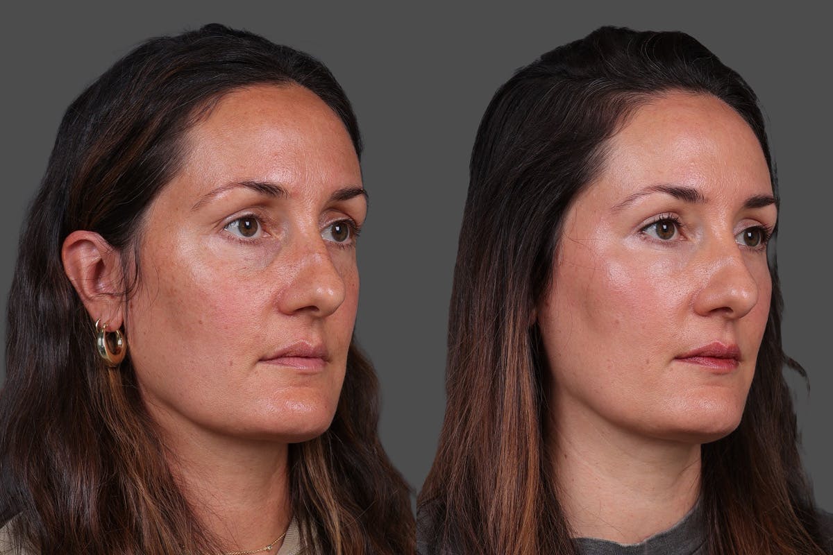 Eyelid Surgery (Blepharoplasty) Before & After Gallery - Patient 398173 - Image 3