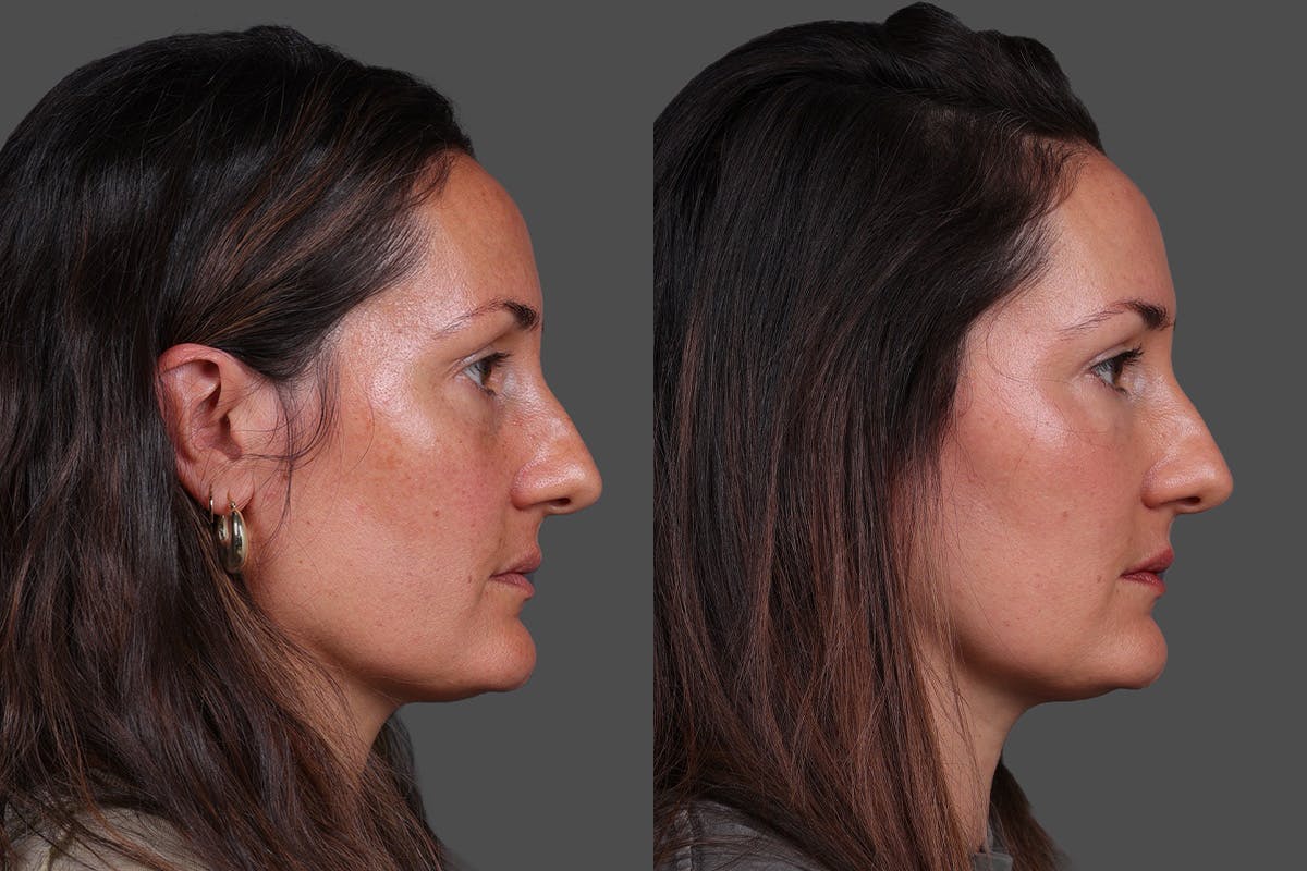 Eyelid Surgery (Blepharoplasty) Before & After Gallery - Patient 398173 - Image 4