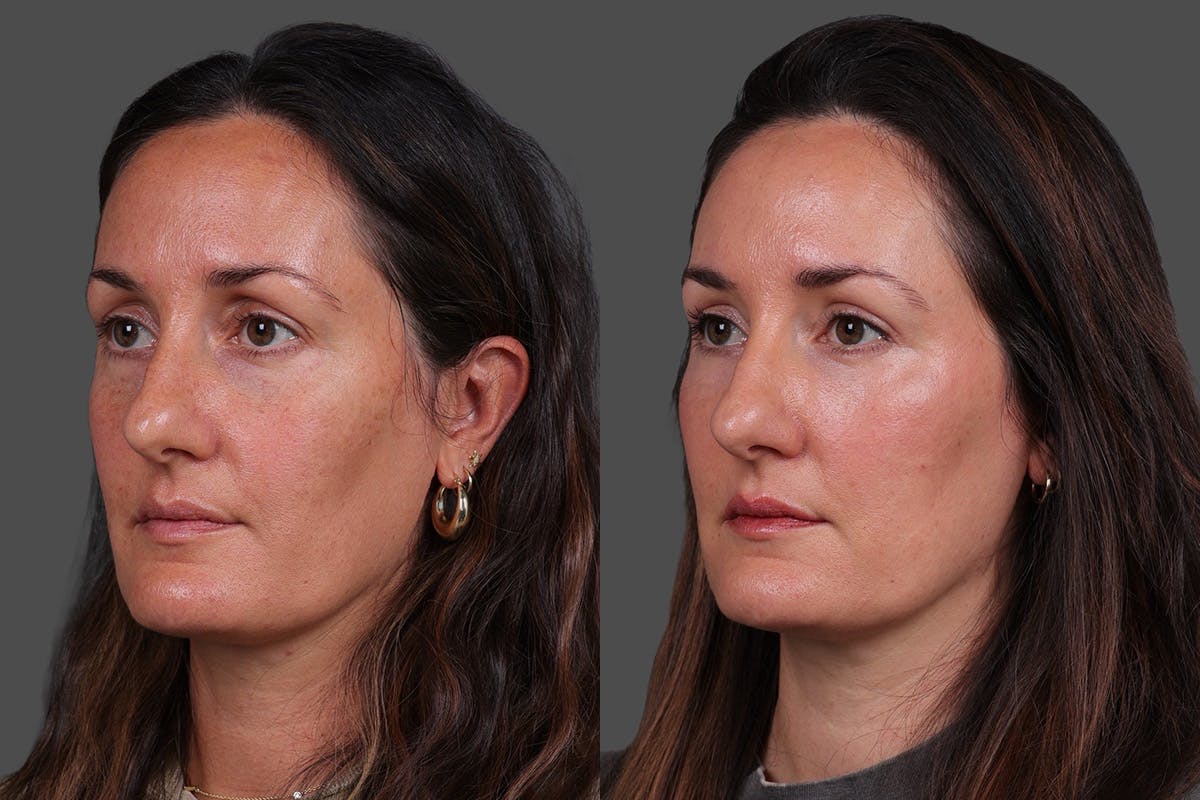 Eyelid Surgery (Blepharoplasty) Before & After Gallery - Patient 398173 - Image 5