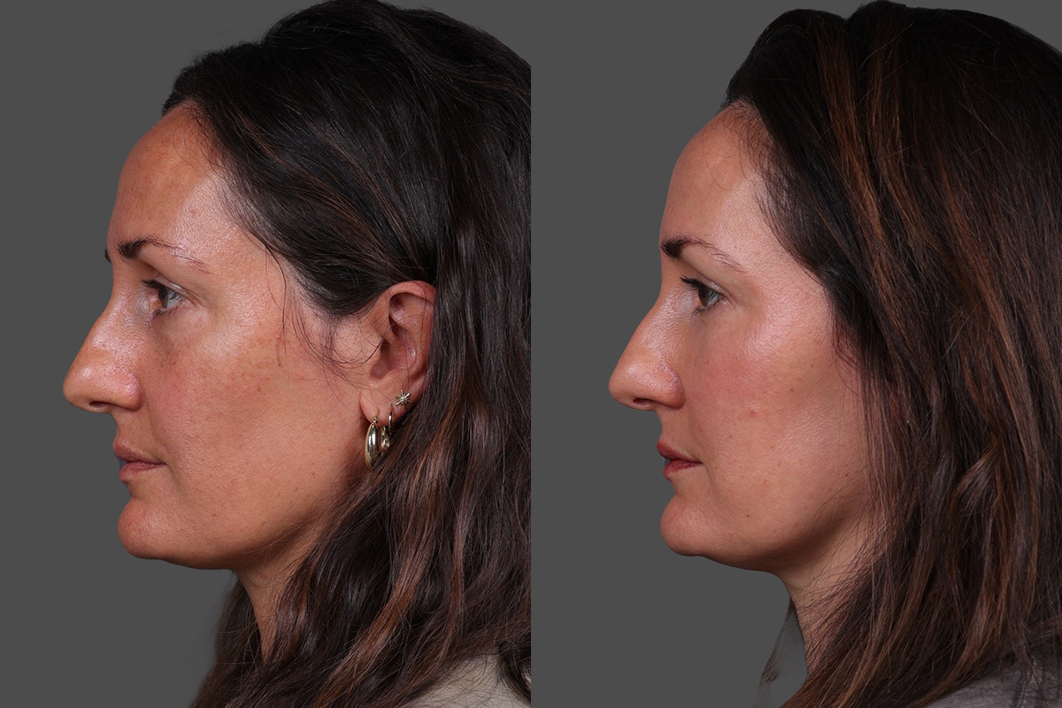 Patient 254833 | CO2 Fractional Laser Before & After Photos