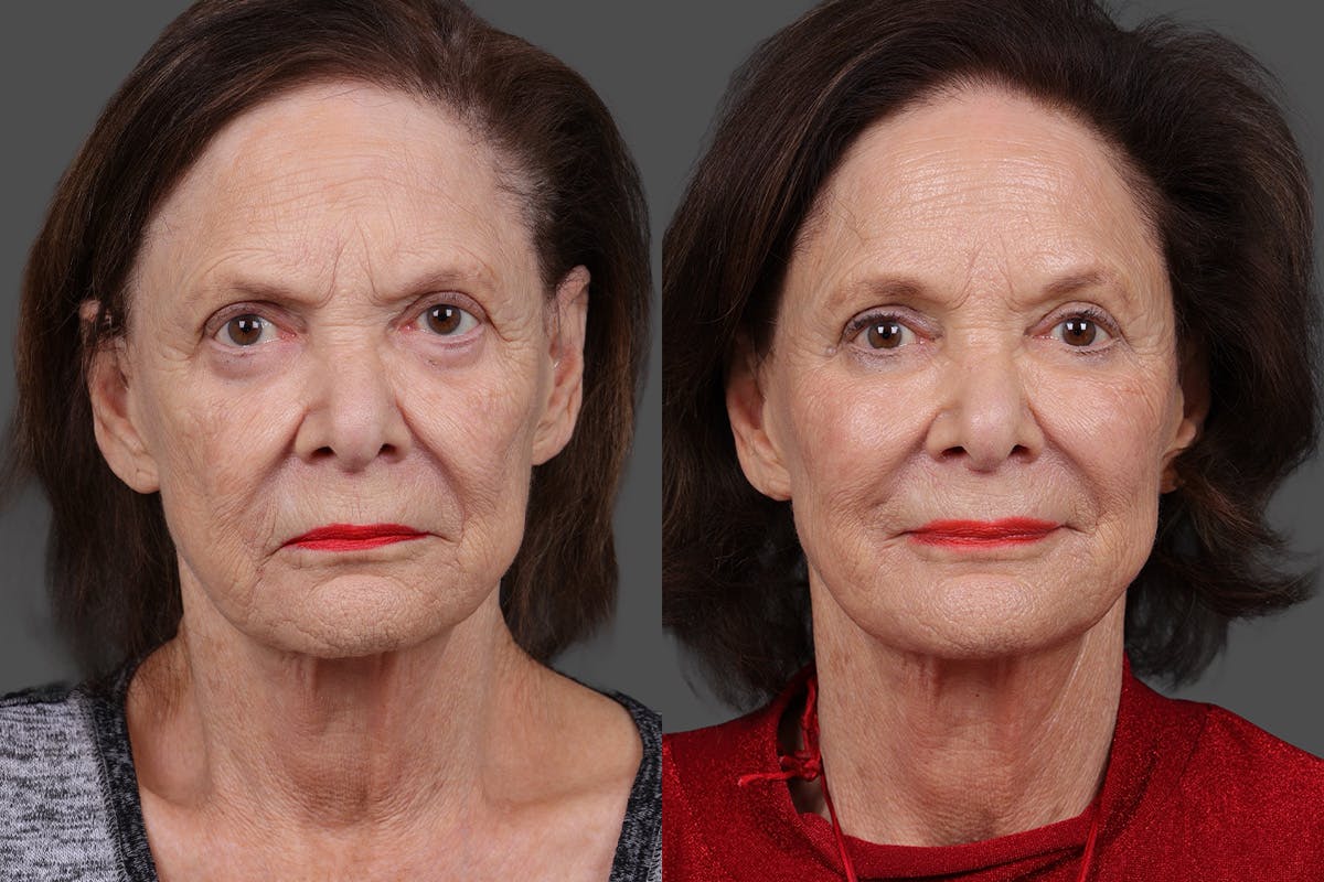 Sculptra Before & After Gallery - Patient 396397 - Image 1
