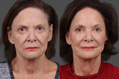 Sculptra Before & After Gallery - Patient 396397 - Image 1