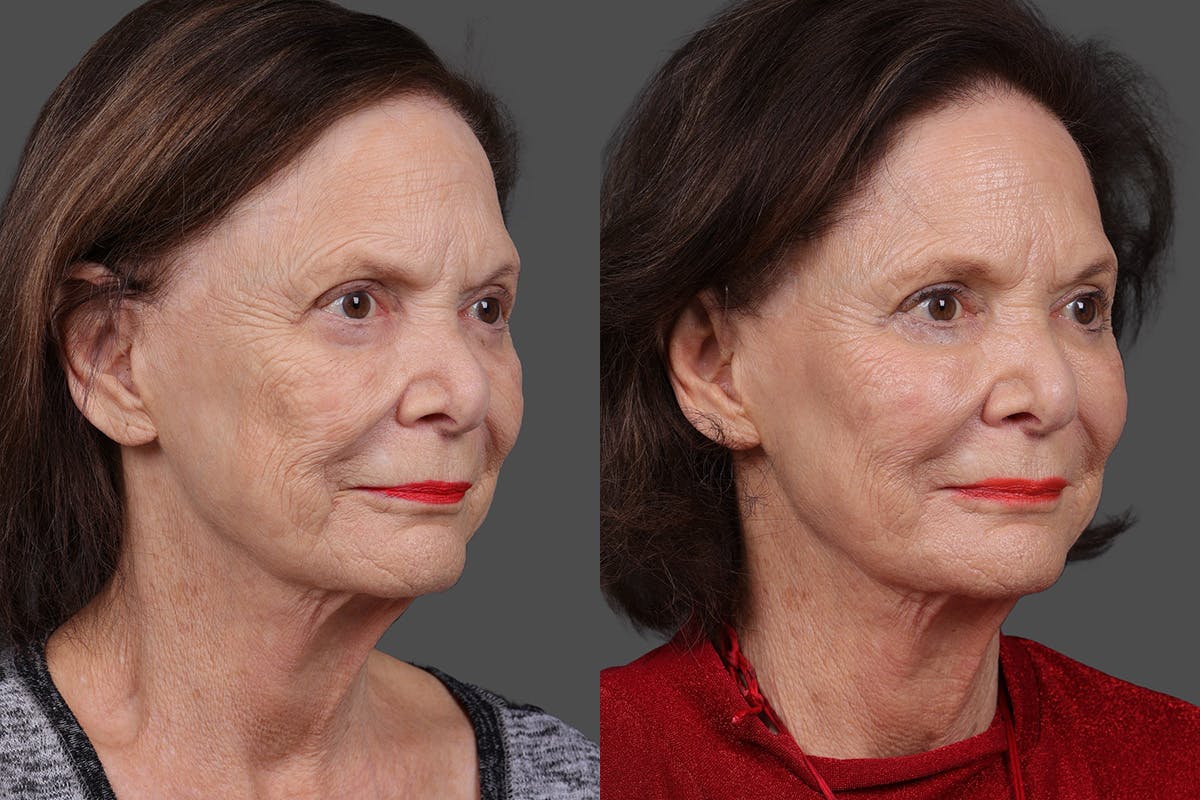 Sculptra Before & After Gallery - Patient 396397 - Image 2