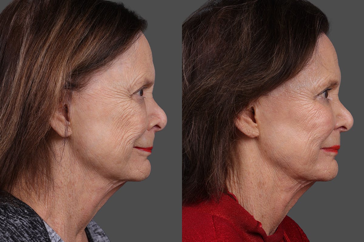 Sculptra Before & After Gallery - Patient 396397 - Image 3