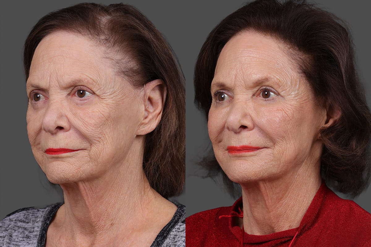 Sculptra Before & After Gallery - Patient 396397 - Image 4