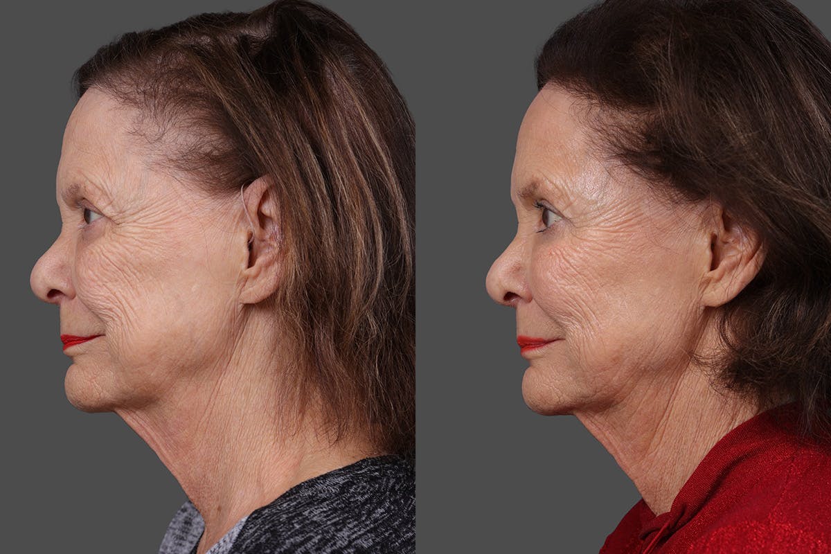 Sculptra Before & After Gallery - Patient 396397 - Image 5