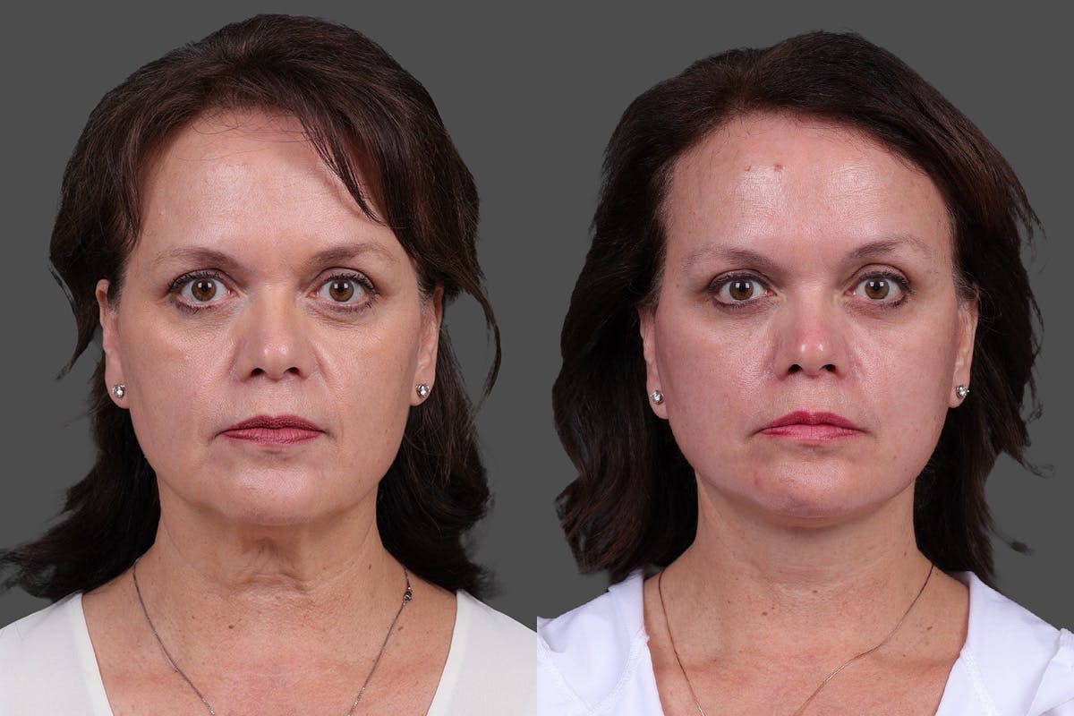 Facelift Before & After Gallery - Patient 271156 - Image 1