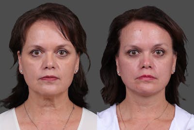Facelift Before & After Gallery - Patient 271156 - Image 1