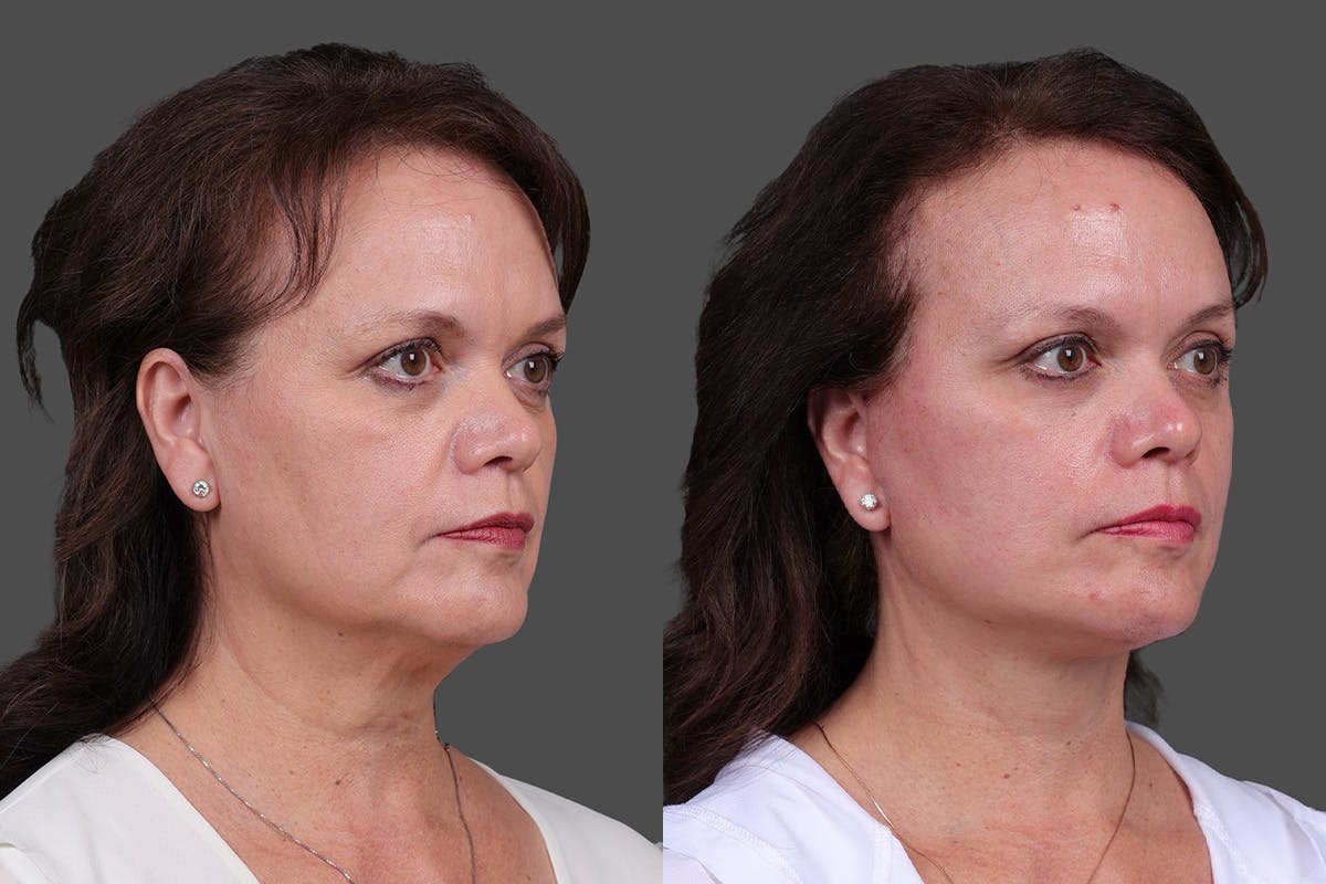 Facelift Before & After Gallery - Patient 271156 - Image 2