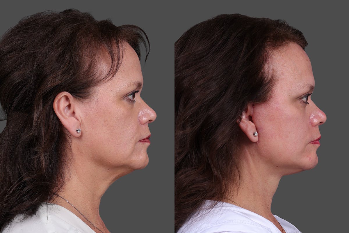 Facelift Before & After Gallery - Patient 271156 - Image 3