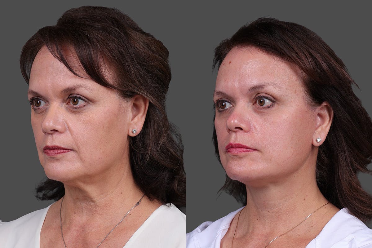 Facelift Before & After Gallery - Patient 271156 - Image 4