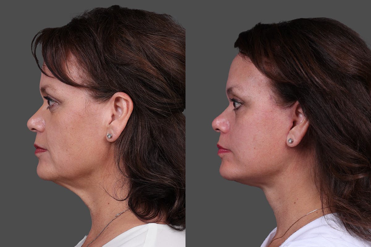 Facelift Before & After Gallery - Patient 271156 - Image 5