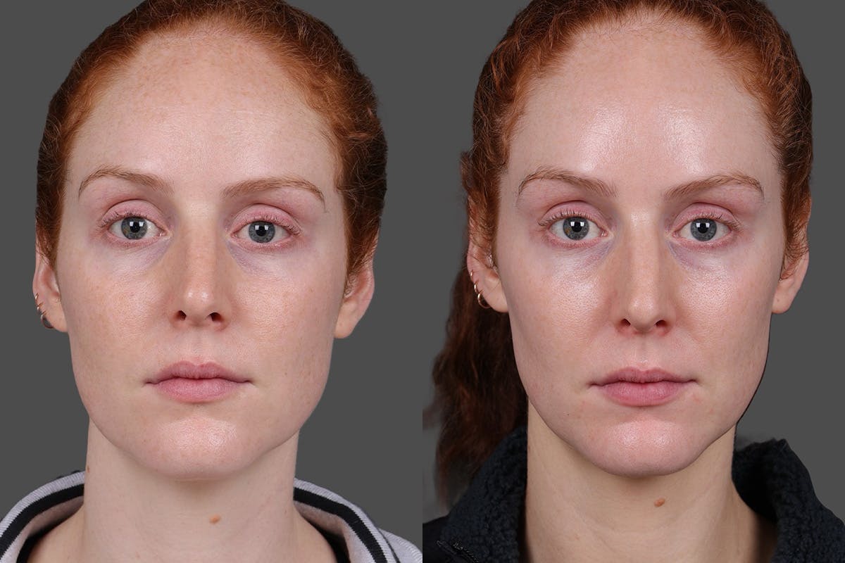 Moxi Before & After Gallery - Patient 290875 - Image 1