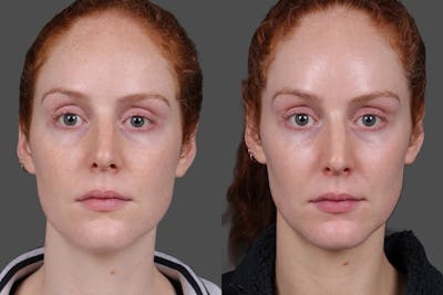 Restylane® Before & After Gallery - Patient 133344 - Image 1