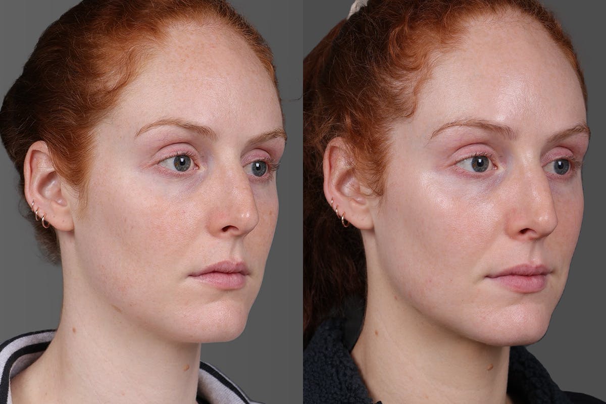 Moxi Before & After Gallery - Patient 290875 - Image 2