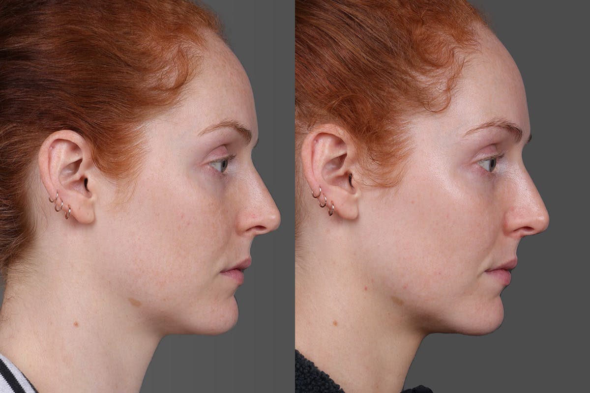Moxi Before & After Gallery - Patient 290875 - Image 3