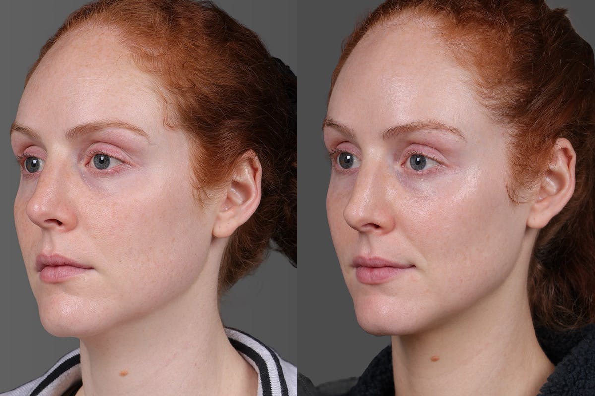 Moxi Before & After Gallery - Patient 290875 - Image 4