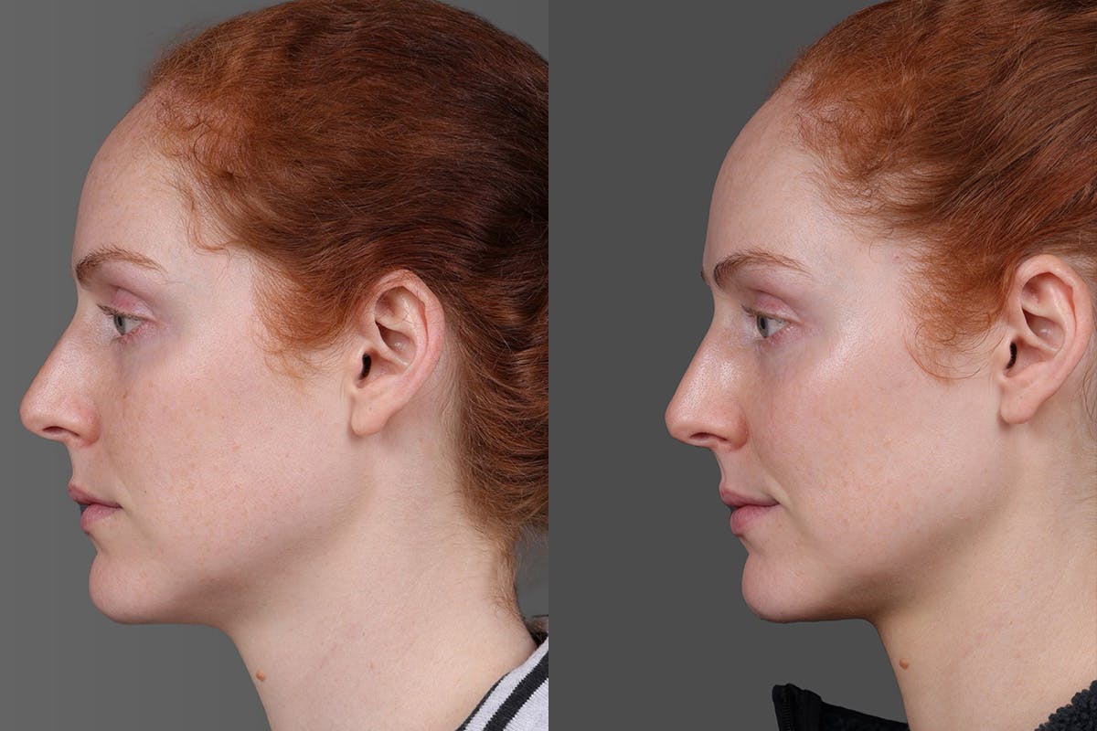 Moxi Before & After Gallery - Patient 290875 - Image 5