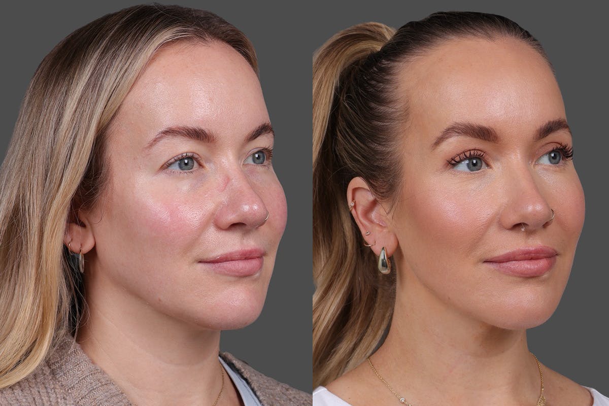 Eyelid Surgery (Blepharoplasty) Before & After Gallery - Patient 164792 - Image 2