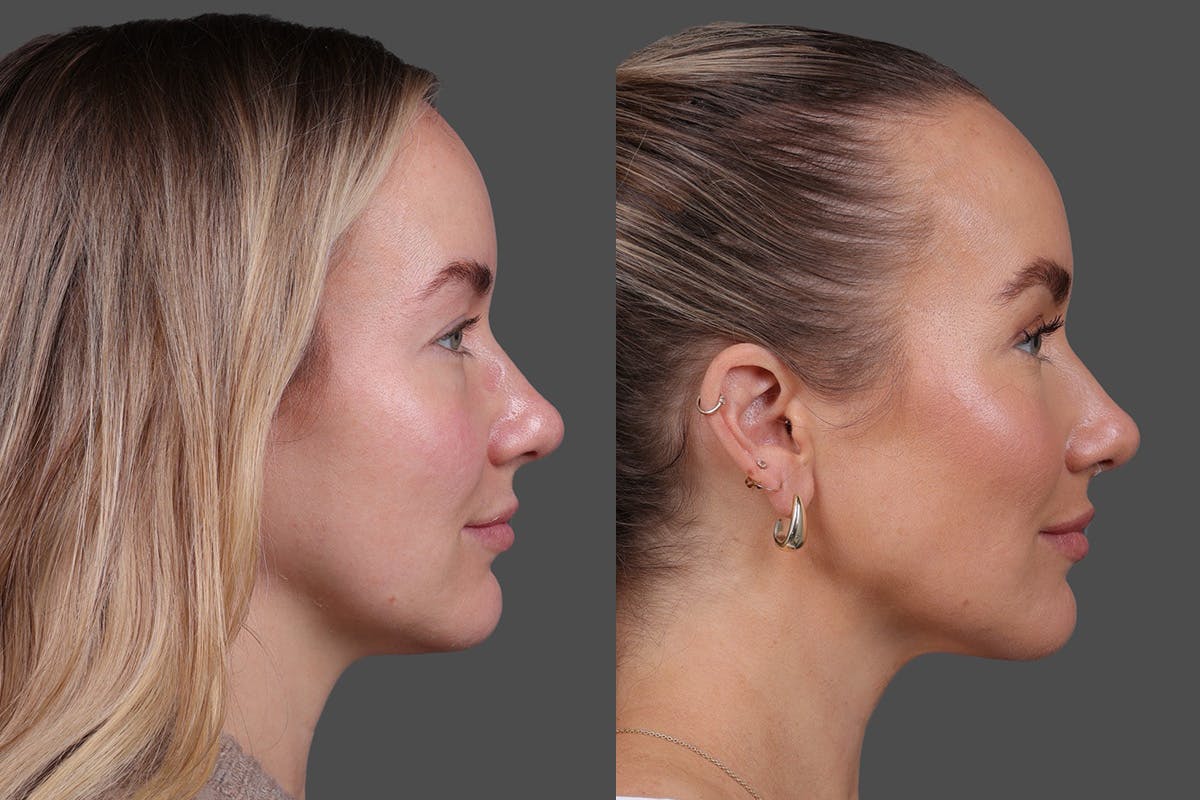 Eyelid Surgery (Blepharoplasty) Before & After Gallery - Patient 164792 - Image 3