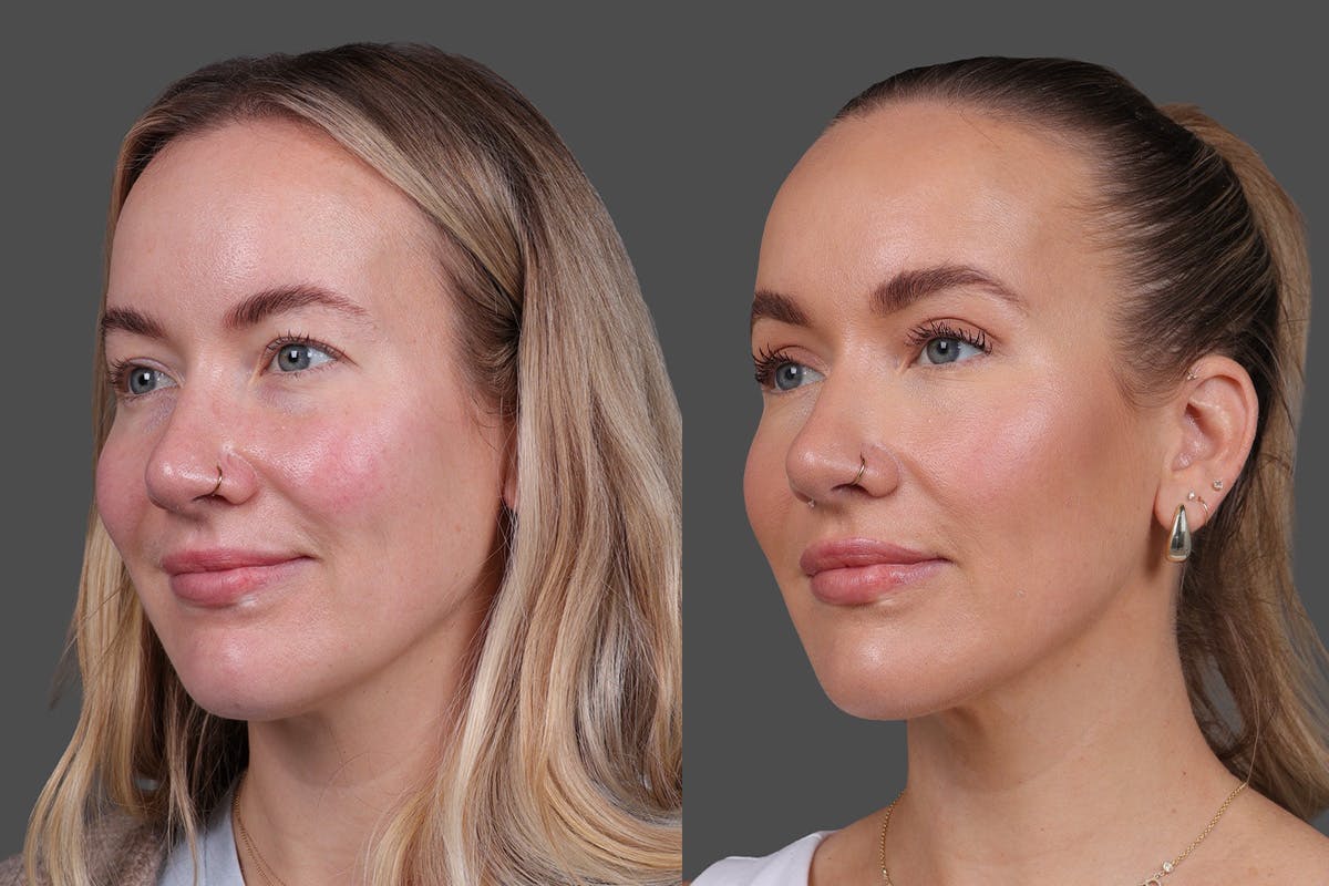 Eyelid Surgery (Blepharoplasty) Before & After Gallery - Patient 164792 - Image 4