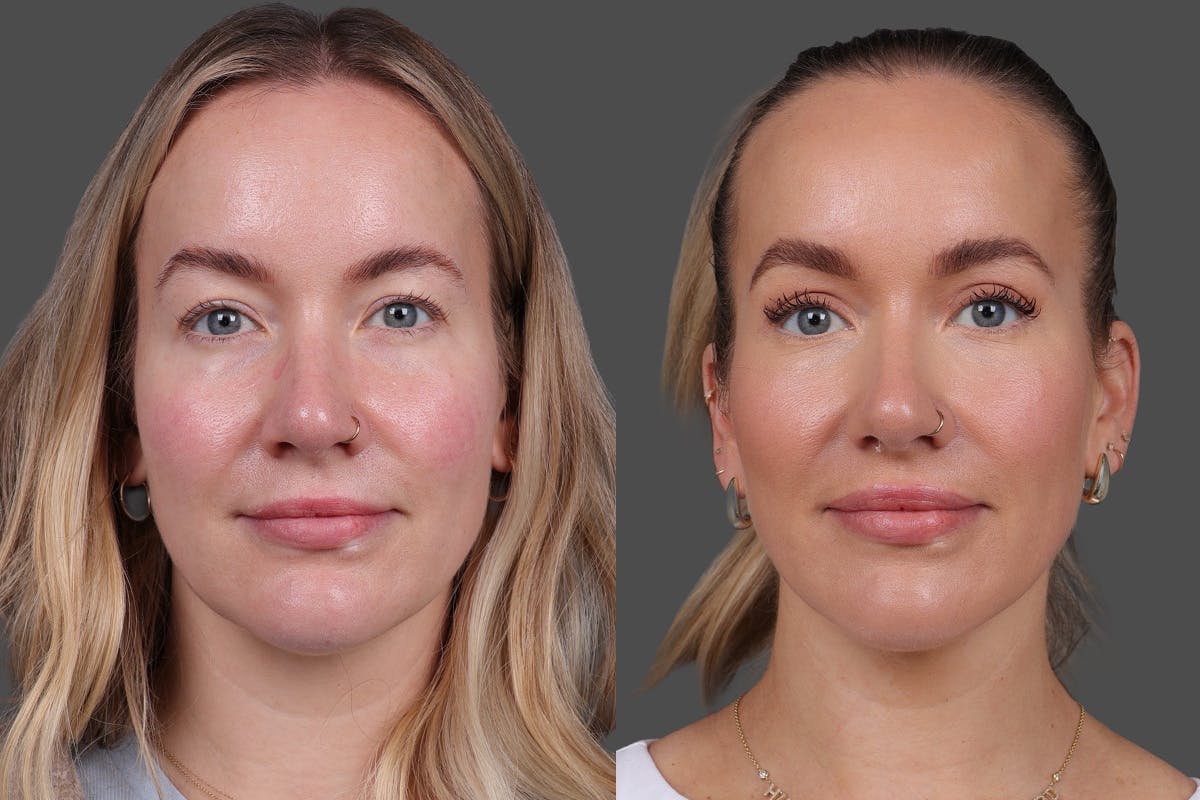 Eyelid Surgery (Blepharoplasty) Before & After Gallery - Patient 164792 - Image 1