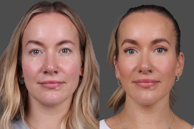 Eyelid Surgery (Blepharoplasty) Before & After Gallery - Patient 164792 - Image 1
