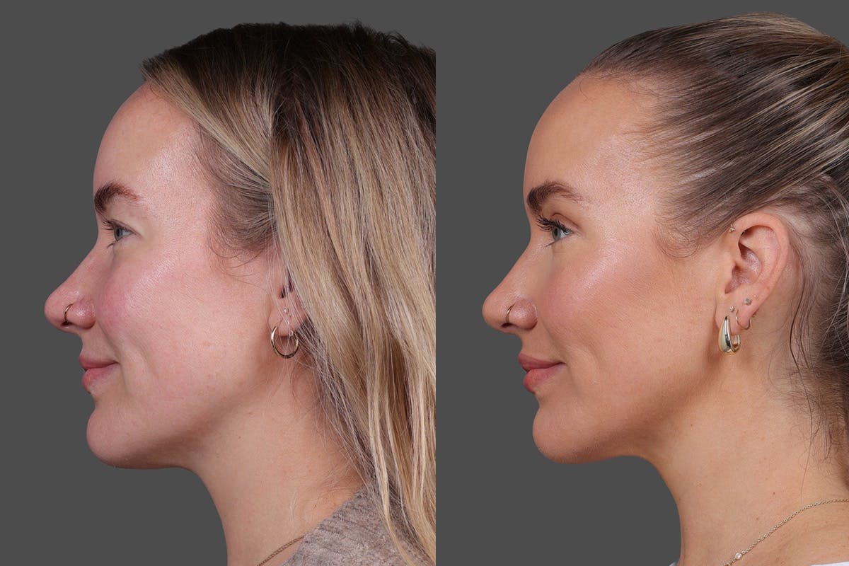 Eyelid Surgery (Blepharoplasty) Before & After Gallery - Patient 164792 - Image 5