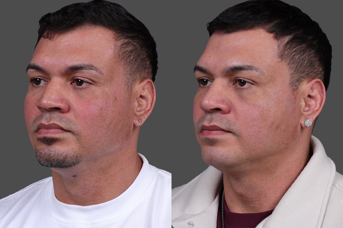 Rhinoplasty Before & After Gallery - Patient 534772 - Image 3