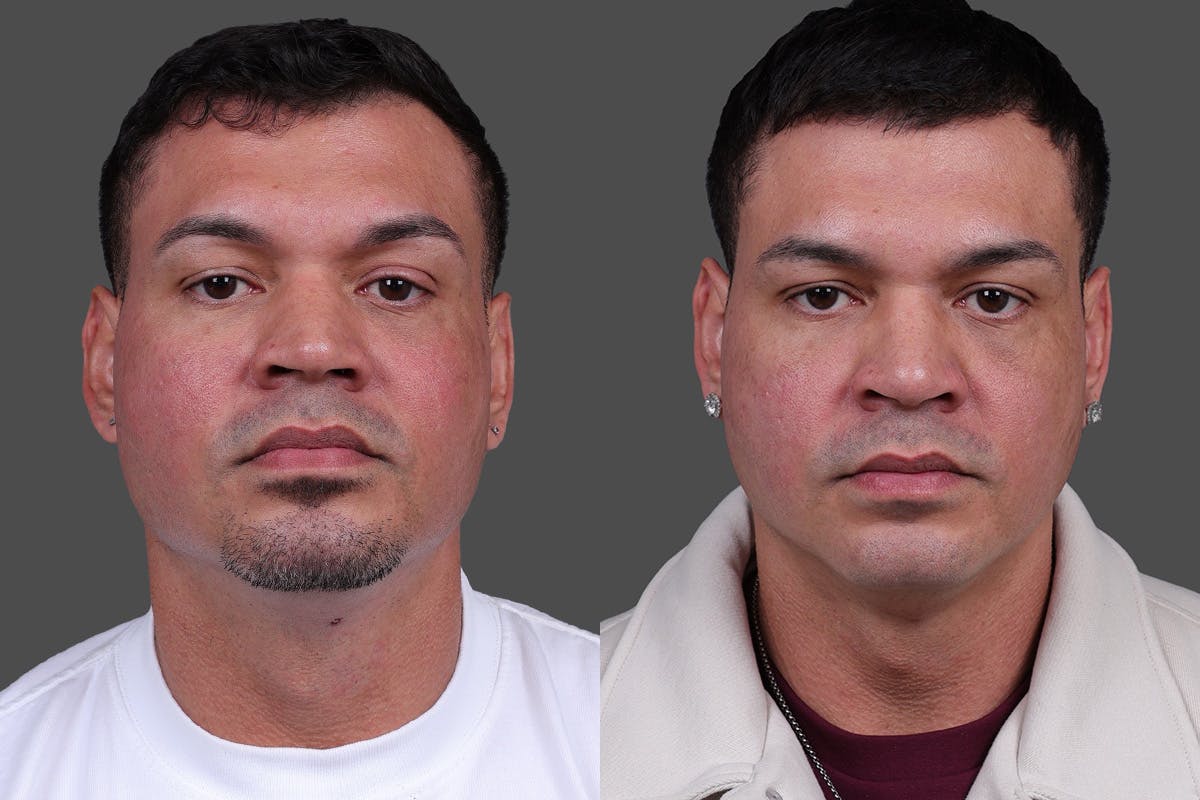 Rhinoplasty Before & After Gallery - Patient 534772 - Image 5