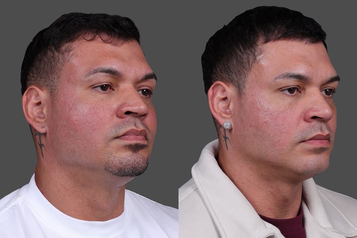 Rhinoplasty Before & After Gallery - Patient 534772 - Image 2